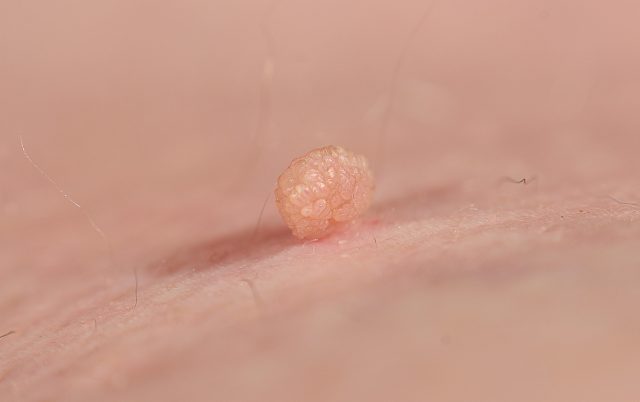 enlever les acrochordons