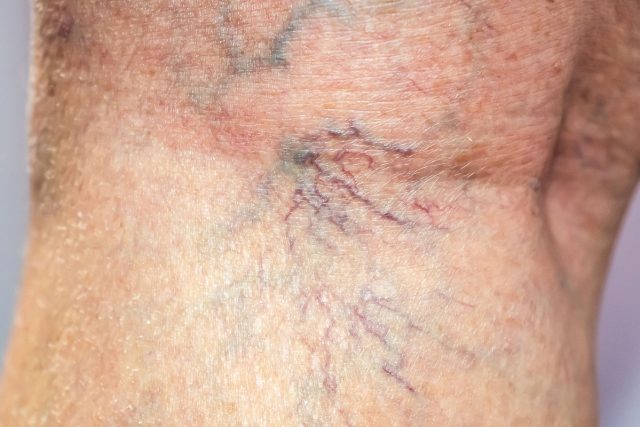 faire disparaître les varicosités