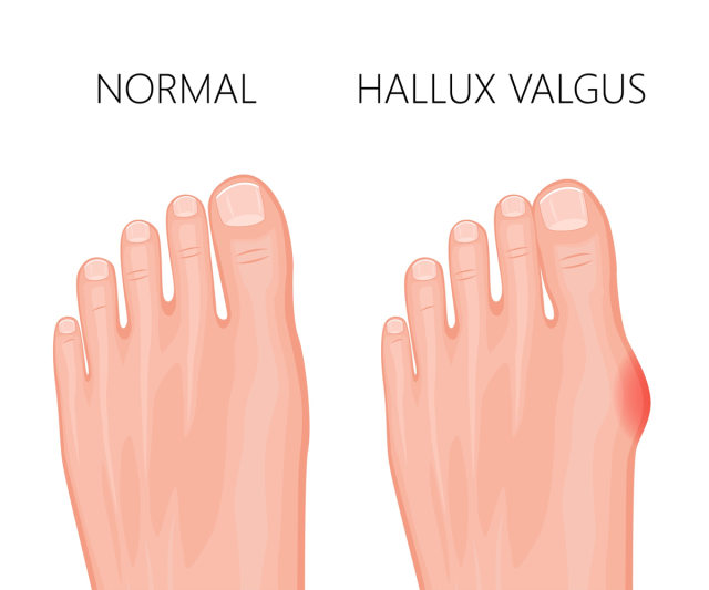 faire disparaître un oignon au pied