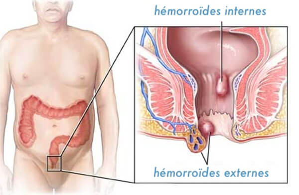 hémorroïdes