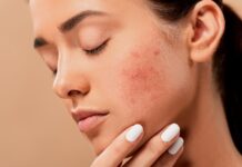 cicatrices d’acné remèdes