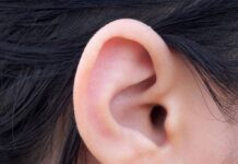 Points noirs dans les oreilles