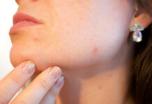 Resserrer les pores dilatés du visage
