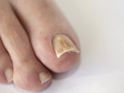 Soigner une mycose des ongles avec de la javel mycose des ongles