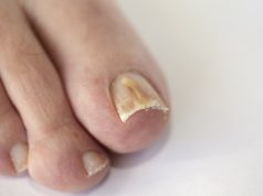 Soigner une mycose des ongles avec de la javel mycose des ongles