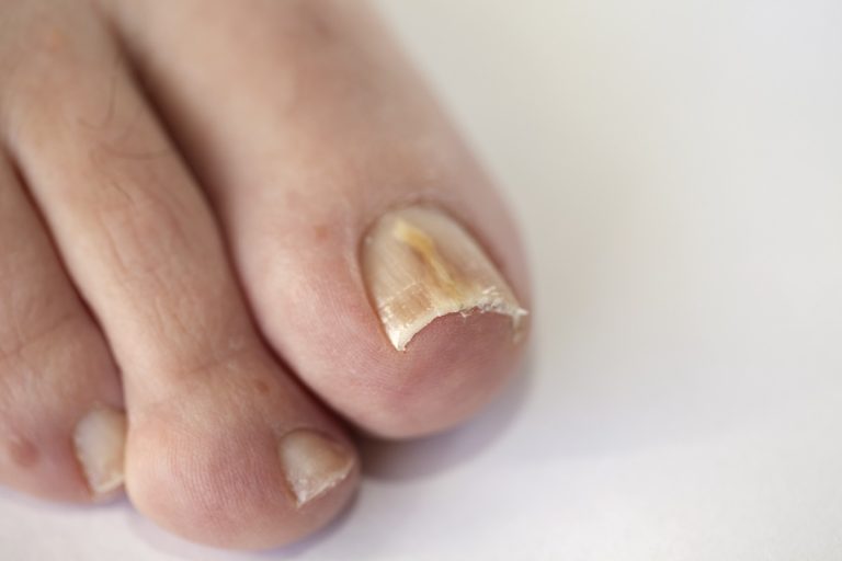 Soigner une mycose des ongles avec de la javel