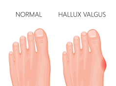 Comment faire disparaître un oignon au pied faire disparaître un oignon au pied