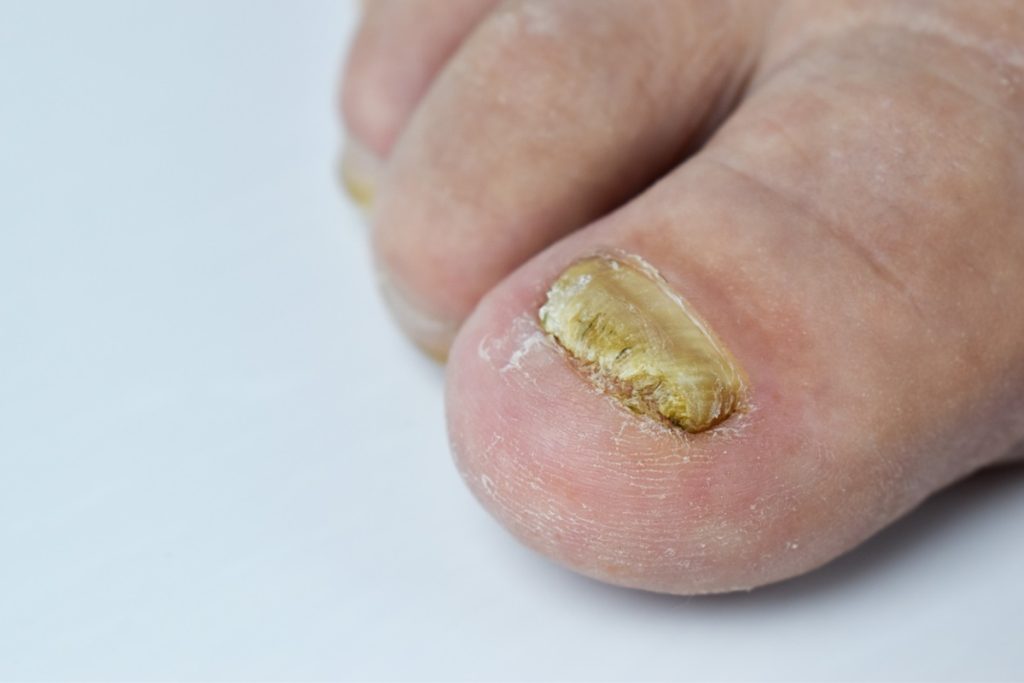 Soigner une mycose des ongles avec de la javel