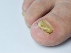 Mycose des pieds – Remèdes naturels de grand-mère mycose des pieds