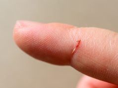 4 astuces de grand-mère pour retirer une épine sans douleur retirer une épine sans douleur