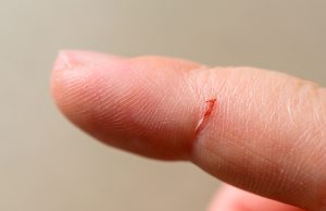 4 astuces de grand-mère pour retirer une épine sans douleur retirer une épine sans douleur