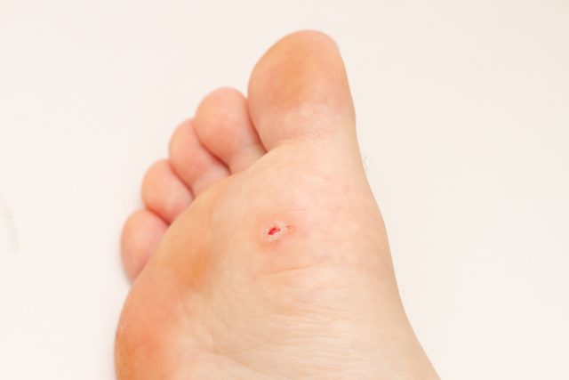 soigner les verrues sans douleur