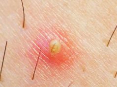 Remèdes contre les poils incarnés Remèdes contre les poils incarnés