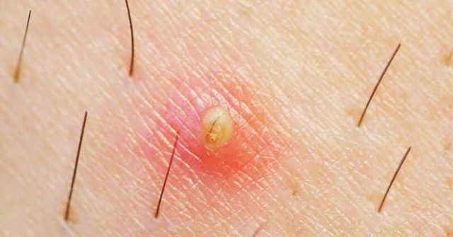 Remèdes contre les poils incarnés