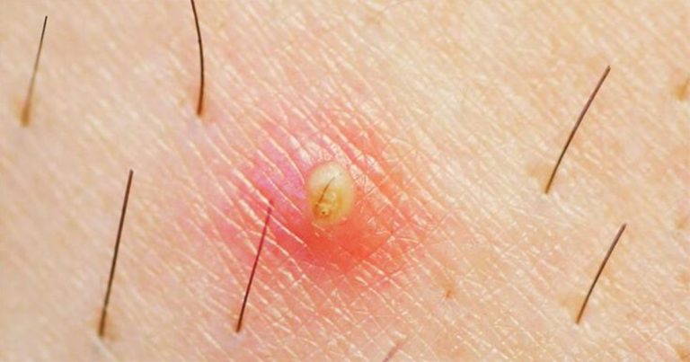 Remèdes contre les poils incarnés
