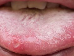 Boutons sur la langue : 11 remèdes de grand-mère boutons sur la langue