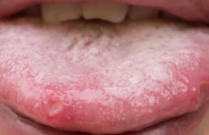 Boutons sur la langue : 11 remèdes de grand-mère boutons sur la langue