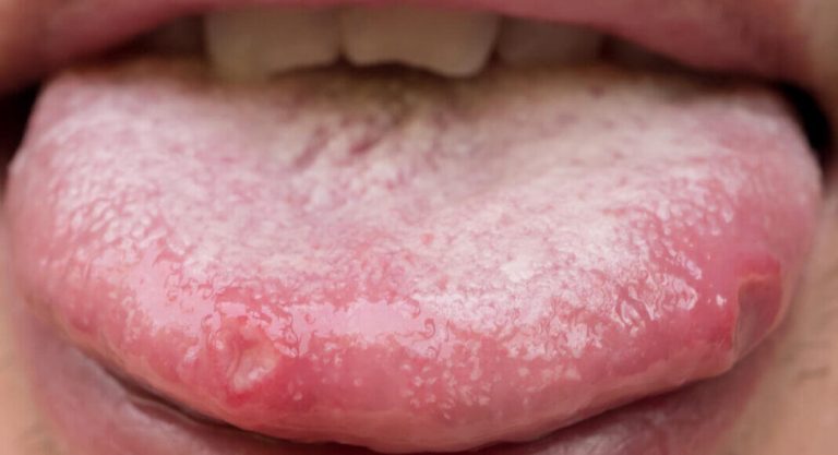 Boutons sur la langue : 11 remèdes de grand-mère