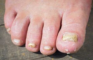 Soigner une mycose – 4 remèdes naturels de grand-mère Soigner une mycose