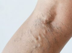 4 astuces et conseils pour éviter les varices éviter les varices