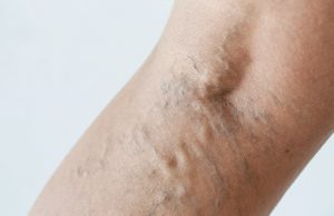 4 astuces et conseils pour éviter les varices éviter les varices