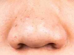 Points noirs : Nos remèdes de grands-mères Points noirs remèdes de grands-mères