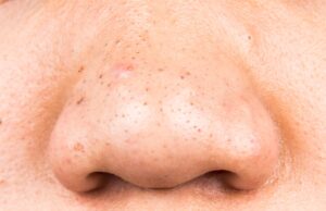 Points noirs : Nos remèdes de grands-mères Points noirs remèdes de grands-mères