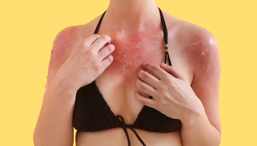 piqure-coups-de-soleil Piqûres et coups de soleil