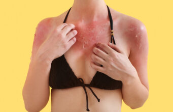 Piqûres et coups de soleil : toutes les astuces pour un été sans bobo Piqûres et coups de soleil