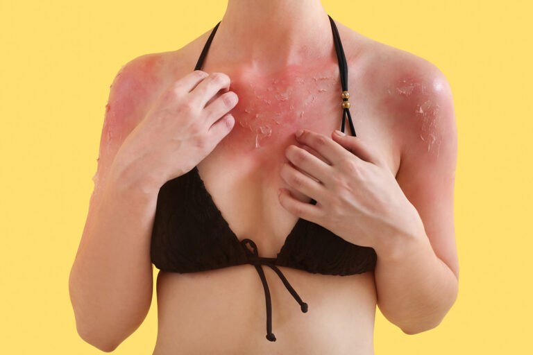 Piqûres et coups de soleil : toutes les astuces pour un été sans bobo