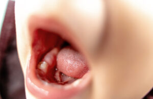 Astuces de grand-mère pour soulager la poussée dentaire de bébé Astuces de grand-mère pour soulager la poussée dentaire de bébé