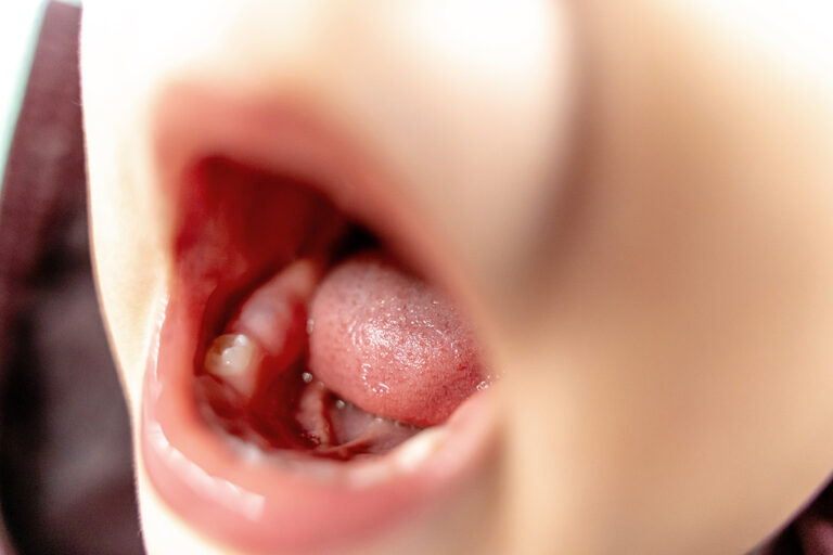 Astuces de grand-mère pour soulager la poussée dentaire de bébé