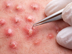 Les meilleures astuces de grand-mère pour faire ressortir un poil incarné faire ressortir un poil incarné