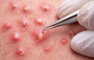 Les meilleures astuces de grand-mère pour faire ressortir un poil incarné faire ressortir un poil incarné