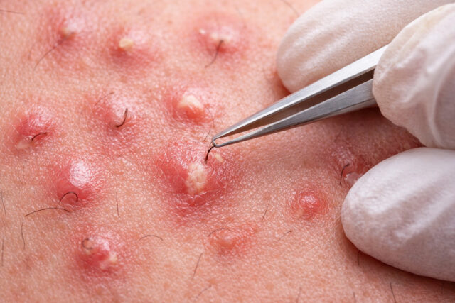 faire ressortir un poil incarné