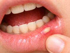 Remèdes de grand-mère pour soigner un aphte chez l’enfant Remèdes de grand-mère pour soigner un aphte chez l’enfant