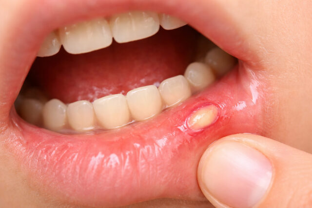 Remèdes de grand-mère pour soigner un aphte chez l’enfant