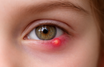 Orgelet à l’œil : astuces et méthodes pour s’en débarrasser efficacement Orgelet à l’œil