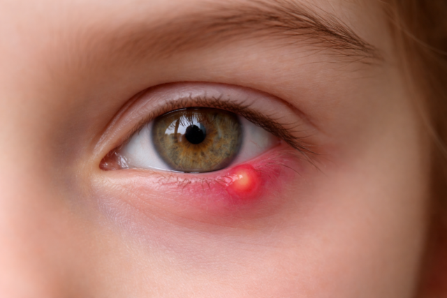 remedes-orgelet Orgelet à l’œil