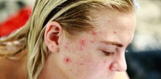 remèdes soigner acné