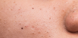 4 astuces contres les points noirs sur la peau