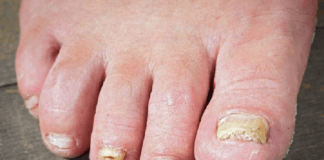 soigner mycose des ongles javel