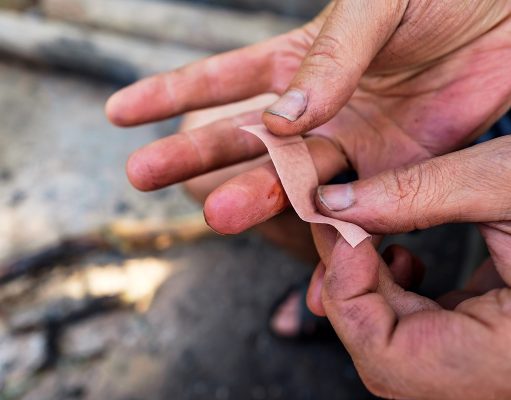Crevasses aux mains – 3 remèdes de grand-mère Crevasses aux mains