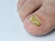 Mycose des pieds – Remèdes naturels de grand-mère mycose des pieds