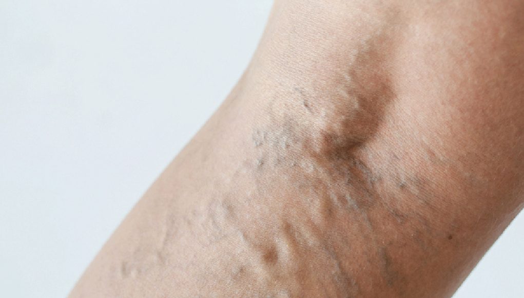 éviter les varices