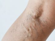 4 astuces et conseils pour éviter les varices éviter les varices