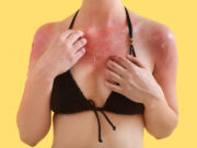 Piqûres et coups de soleil : toutes les astuces pour un été sans bobo Piqûres et coups de soleil